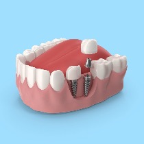 Dental Implant